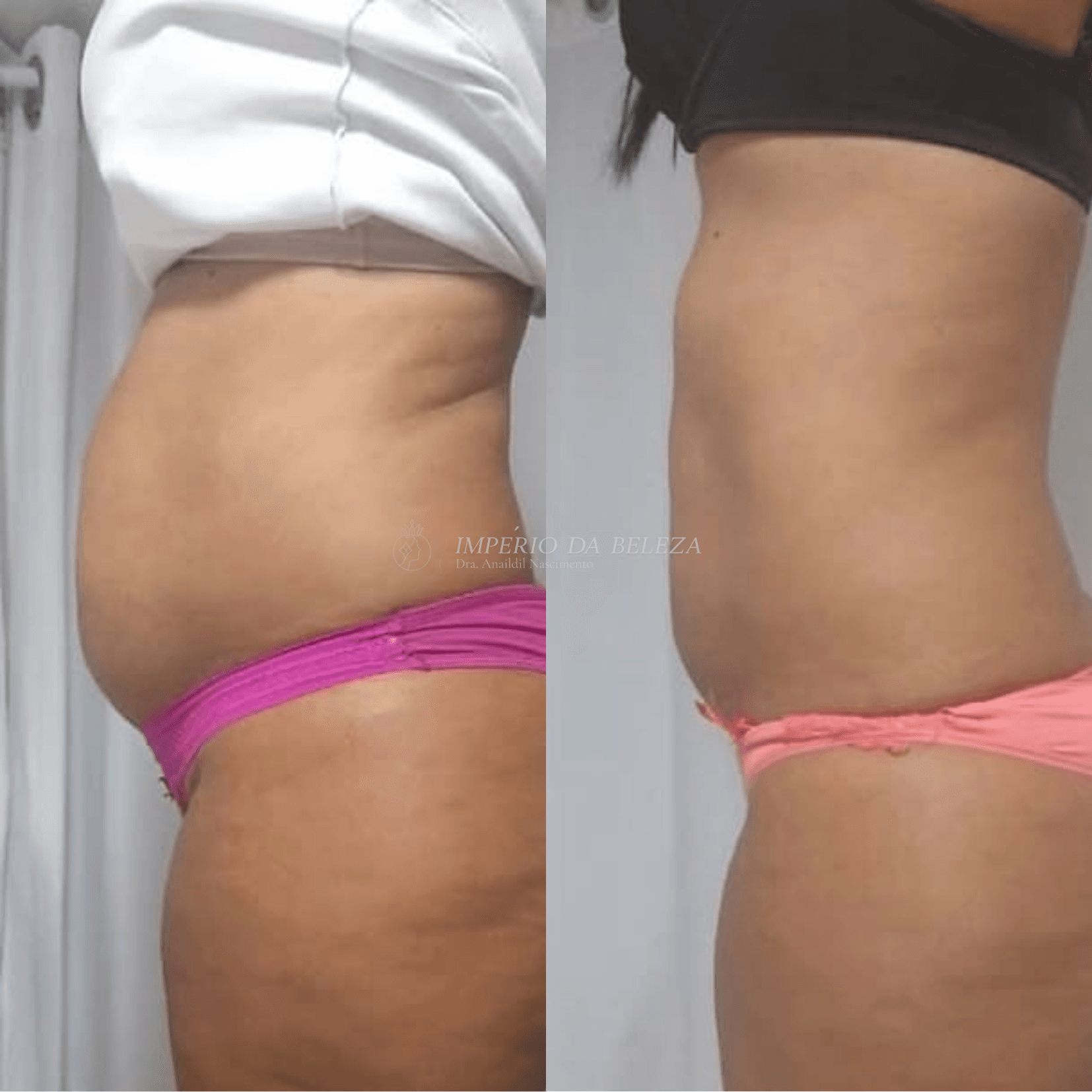 Resultado de tratamento corporal