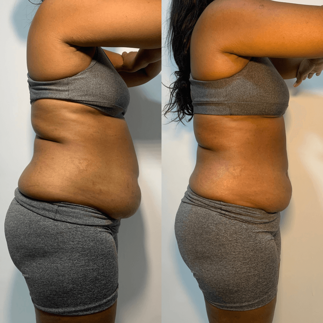 Resultado de procedimento estético - Transformação real